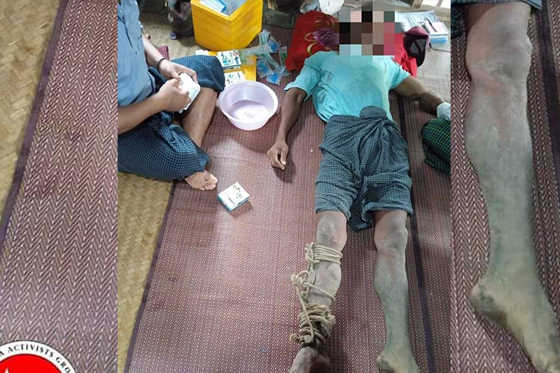 Internally displaced people (IDPs) from Zaw Chaung Village in Kanbalu Township, Sagaing Region, receive treatment for snakebites. (Photo: Kyunhla Activists Group)